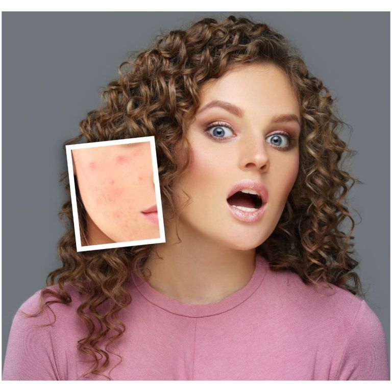 flamenco gel anti-acne espinillas con acido salicilico 30 g